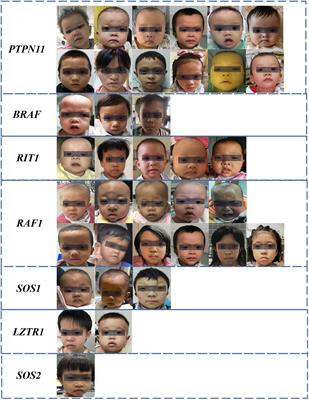 Automated Facial Recognition for Noonan Syndrome Using Novel Deep Convolutional Neural Network With Additive Angular Margin Loss